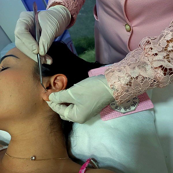 Acupuntura e Auriculoterapia